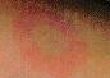 Bull's Eye Rash